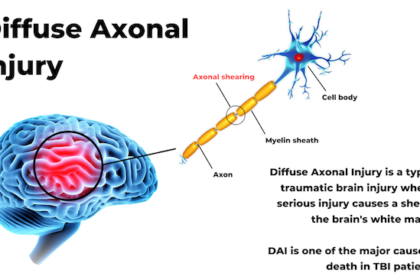 cacat permanen, Diffuse axonal injury, penganiayaan david, david alami Diffuse axonal injury